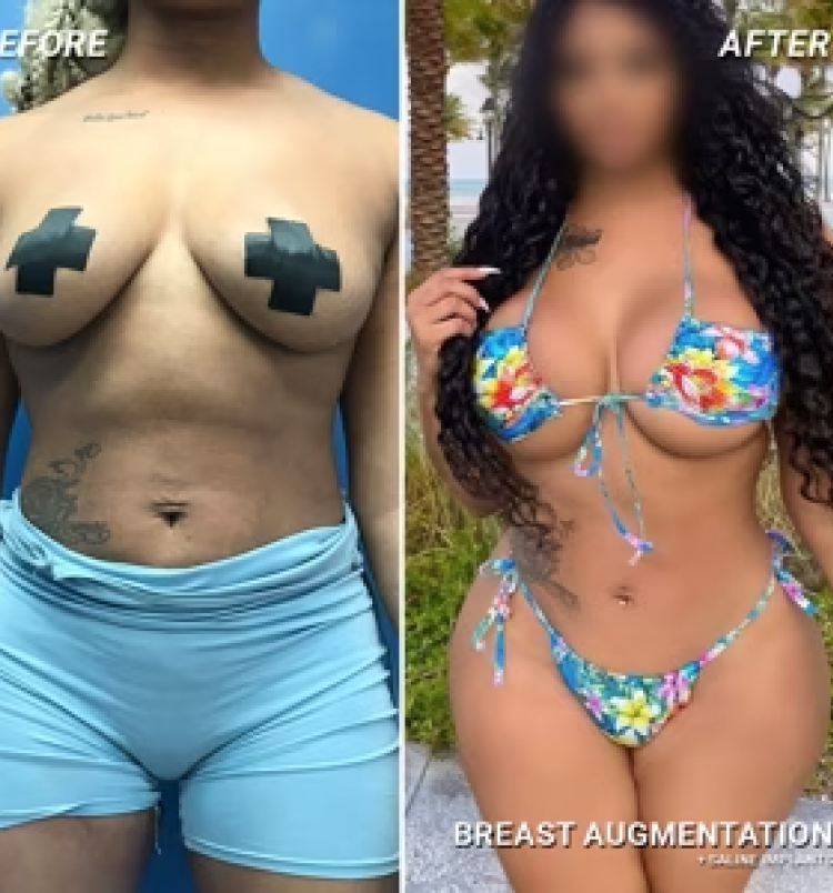 Brazilian Butt Lift BBL before and after Dr. De Jesus Miami