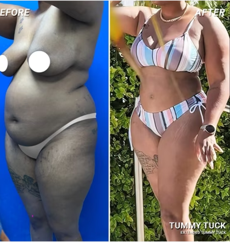 Mommy Makeover before and after Dr. De Jesus Miami