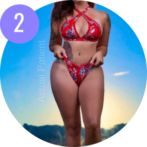Tummy Tuck Miami